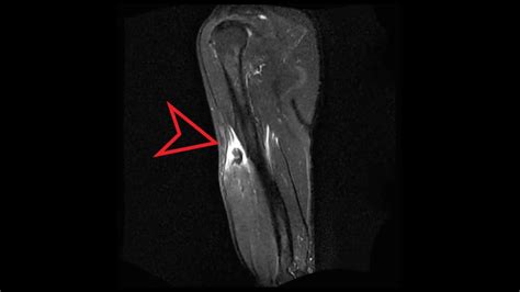 test for bicep tendon tear|mri for biceps tendon rupture.